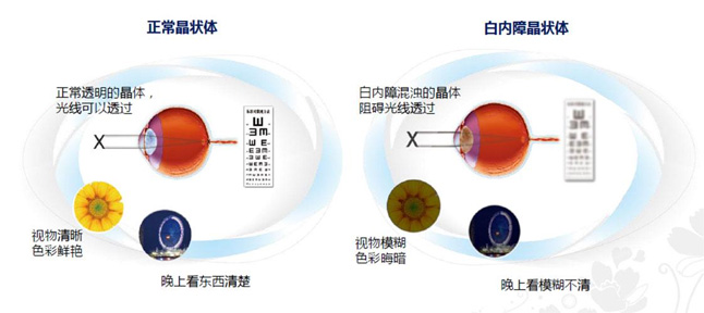 白內(nèi)障和老花眼區(qū)別